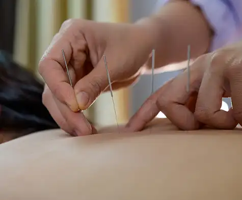 Acupuncture