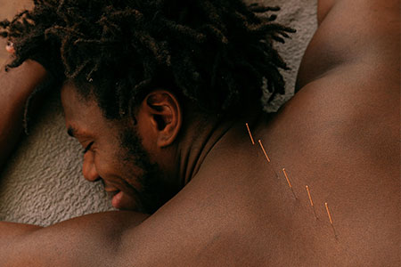 Man lying on back with acupuncture needles in his back