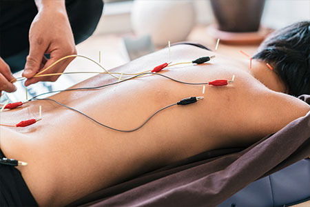 Person with electroacupuncture on back for pain management
