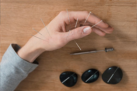 person's hand with acupuncture needles in it and rocks with needles by it